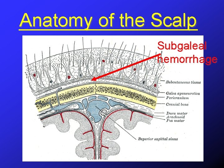 Anatomy of the Scalp Subgaleal hemorrhage 