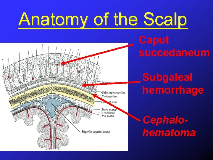 Anatomy of the Scalp Caput succedaneum Subgaleal hemorrhage Cephalohematoma 