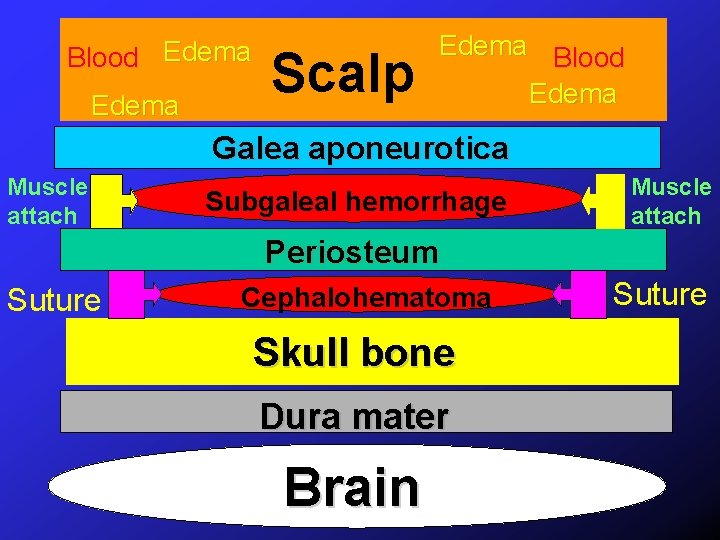 Blood Edema Scalp Edema Blood Edema Galea aponeurotica Muscle attach Subgaleal hemorrhage Muscle attach