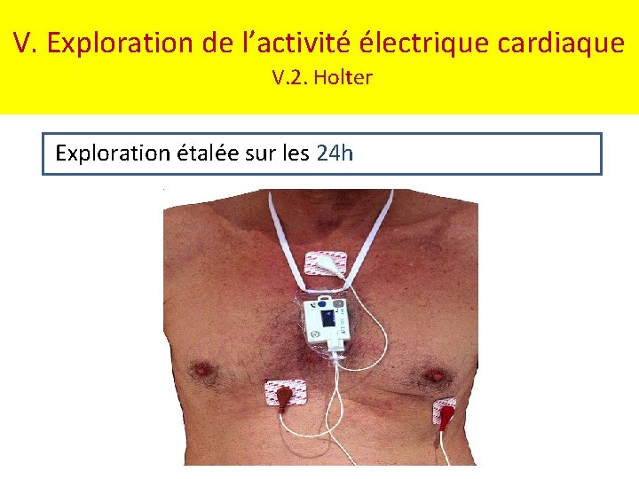 V. Exploration de l’activité électrique cardiaque V. 2. Holter Exploration étalée sur les 24
