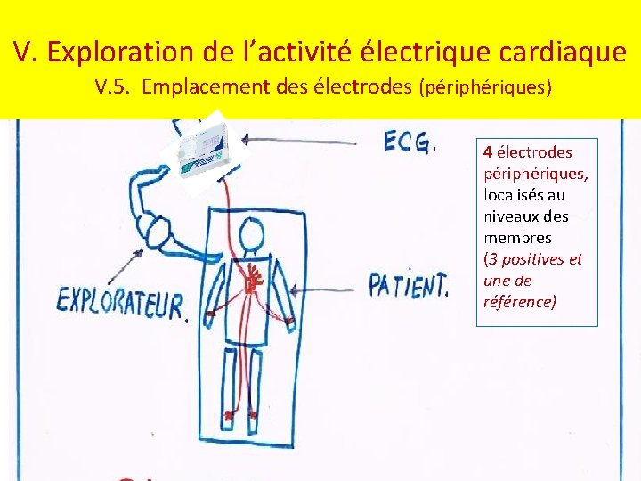 V. Exploration de l’activité électrique cardiaque V. 5. Emplacement des électrodes (périphériques) 4 électrodes