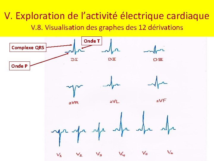 V. Exploration de l’activité électrique cardiaque V. 8. Visualisation des graphes des 12 dérivations