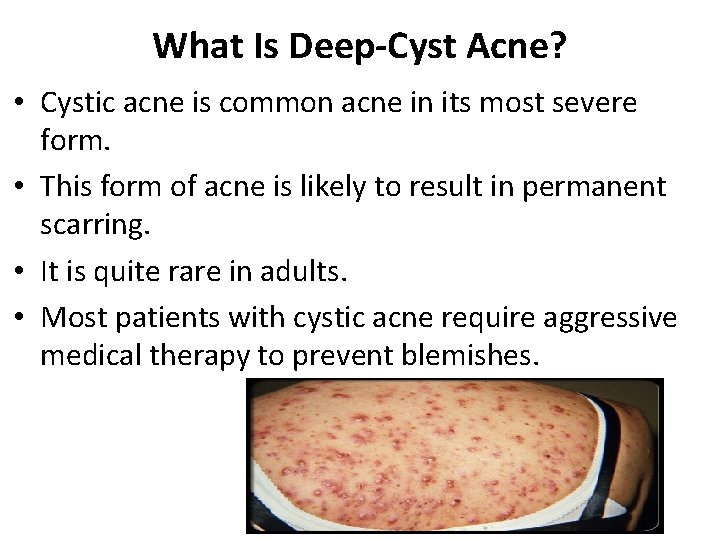 What Is Deep-Cyst Acne? • Cystic acne is common acne in its most severe