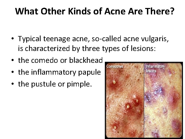 What Other Kinds of Acne Are There? • Typical teenage acne, so-called acne vulgaris,