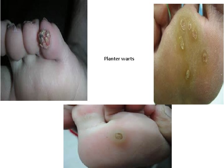 Planter warts 