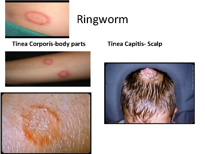 Ringworm Tinea Corporis-body parts Tinea Capitis- Scalp 