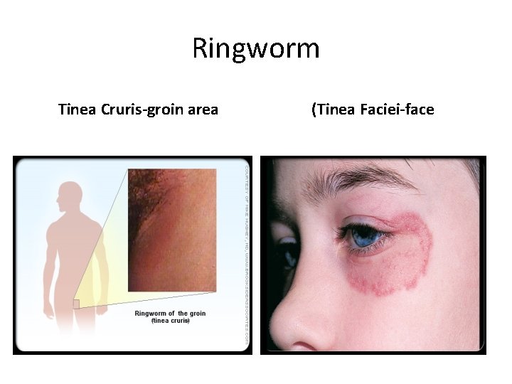 Ringworm Tinea Cruris-groin area (Tinea Faciei-face 