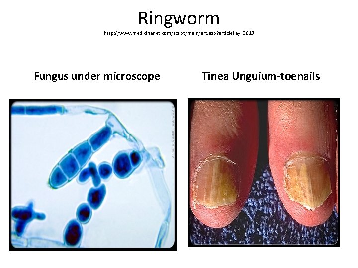 Ringworm http: //www. medicinenet. com/script/main/art. asp? articlekey=3813 Fungus under microscope Tinea Unguium-toenails 