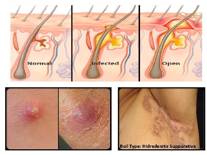 Boil Type: Hidradenitis Suppurativa 