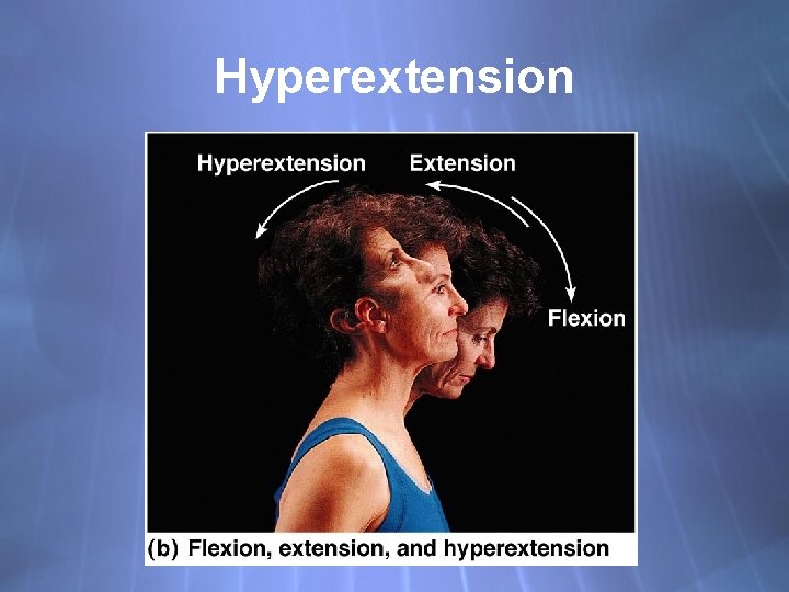 Hyperextension 