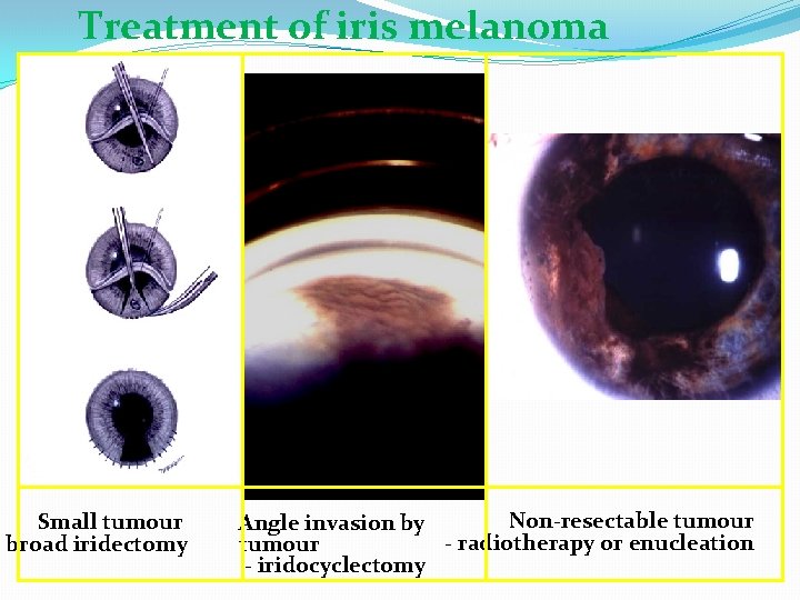 Treatment of iris melanoma Small tumour - broad iridectomy Non-resectable tumour Angle invasion by
