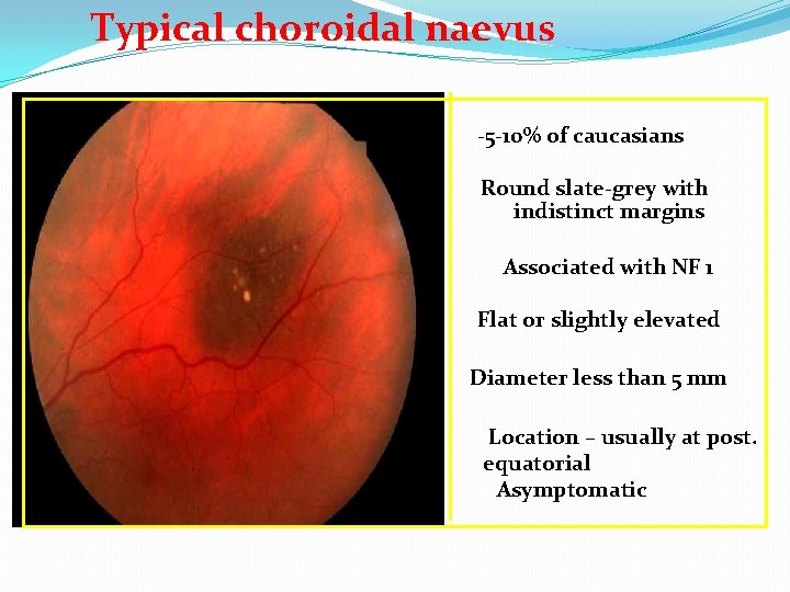Typical choroidal naevus -5 -10% of caucasians Round slate-grey with indistinct margins Associated with