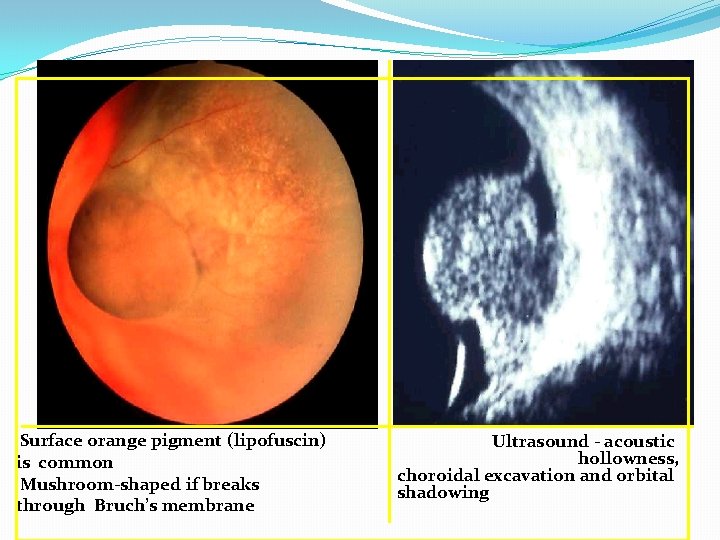 Surface orange pigment (lipofuscin) is common Mushroom-shaped if breaks through Bruch’s membrane Ultrasound -