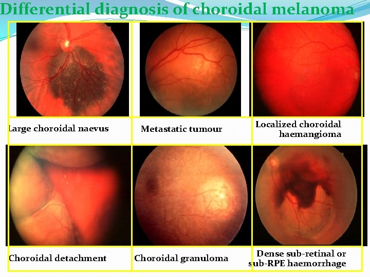 Differential diagnosis of choroidal melanoma Large choroidal naevus Metastatic tumour Localized choroidal haemangioma Choroidal
