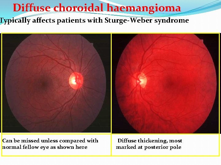 Diffuse choroidal haemangioma Typically affects patients with Sturge-Weber syndrome Can be missed unless compared