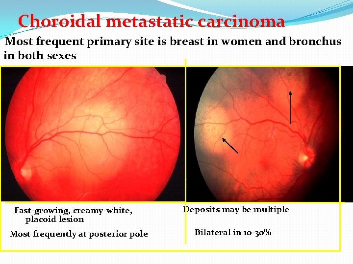 Choroidal metastatic carcinoma Most frequent primary site is breast in women and bronchus in