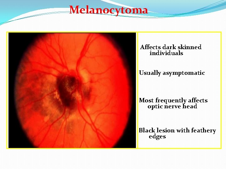Melanocytoma Affects dark skinned individuals Usually asymptomatic Most frequently affects optic nerve head Black
