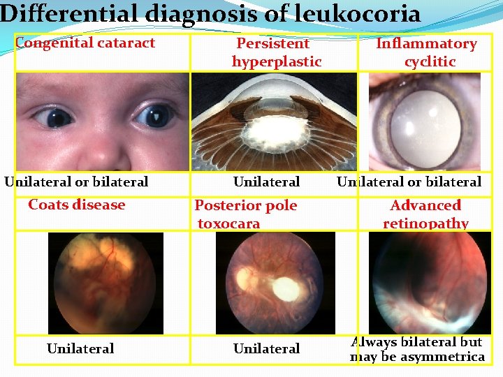 Differential diagnosis of leukocoria Congenital cataract Unilateral or bilateral Coats disease Unilateral Persistent hyperplastic