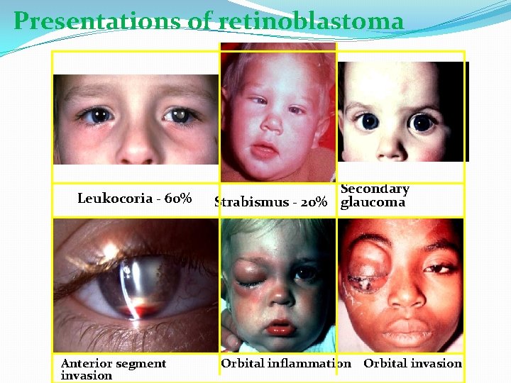 Presentations of retinoblastoma Leukocoria - 60% Anterior segment invasion Secondary Strabismus - 20% glaucoma
