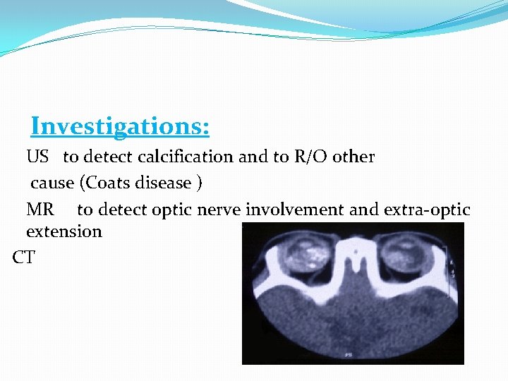 Investigations: US to detect calcification and to R/O other cause (Coats disease ) MR