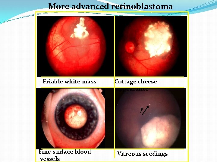 More advanced retinoblastoma Friable white mass Fine surface blood vessels Cottage cheese appearance Vitreous