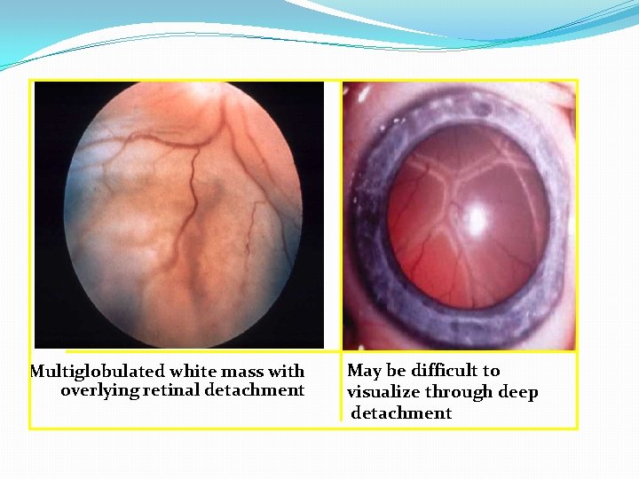 Multiglobulated white mass with overlying retinal detachment May be difficult to visualize through deep