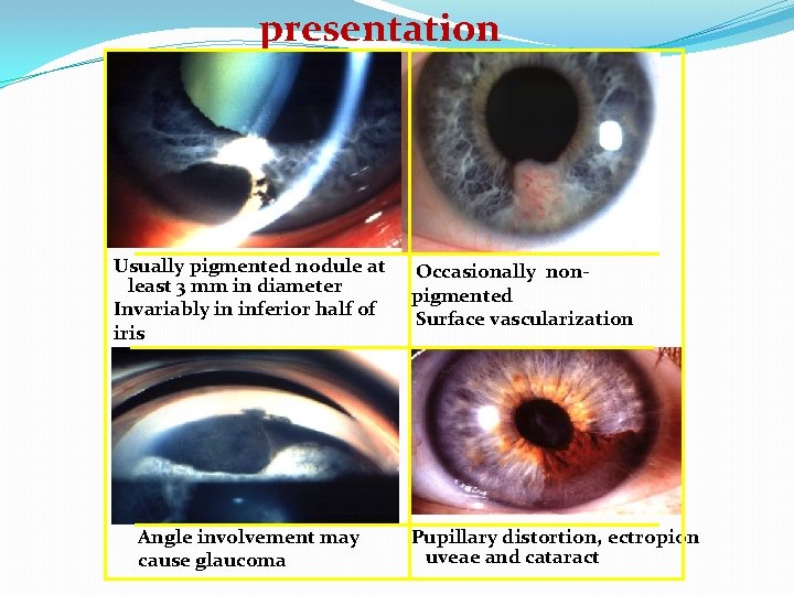 presentation Usually pigmented nodule at least 3 mm in diameter Invariably in inferior half