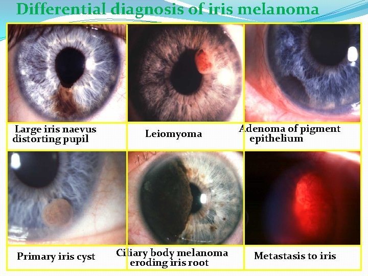 Differential diagnosis of iris melanoma Large iris naevus distorting pupil Leiomyoma Primary iris cyst