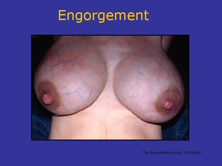 Engorgement The Breastfeeding Atlas, 3 rd Edition 