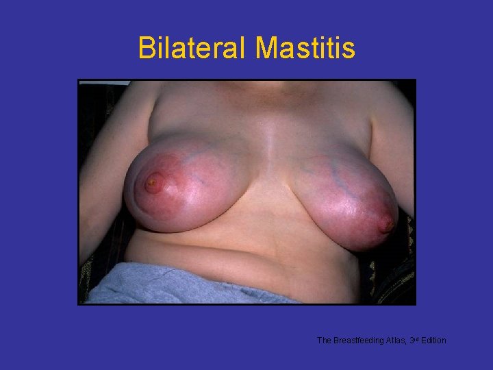 Bilateral Mastitis The Breastfeeding Atlas, 3 rd Edition 