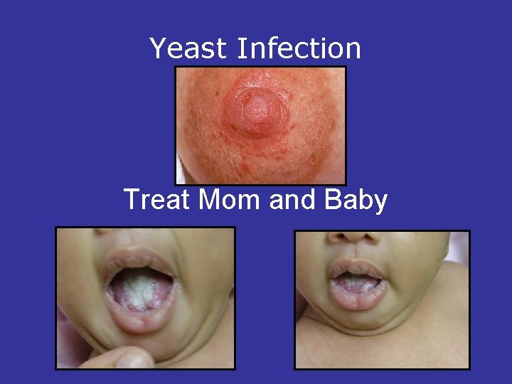 Yeast Infection Treat Mom and Baby 