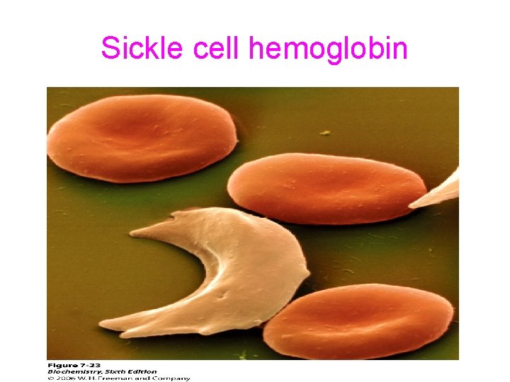Sickle cell hemoglobin 