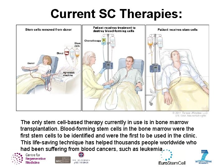 Current SC Therapies: The only stem cell-based therapy currently in use is in bone