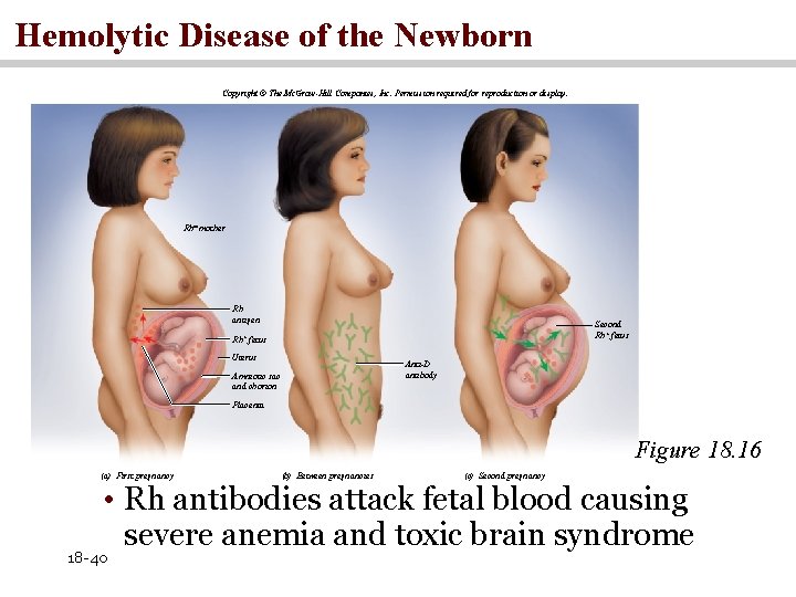 Hemolytic Disease of the Newborn Copyright © The Mc. Graw-Hill Companies, Inc. Permission required
