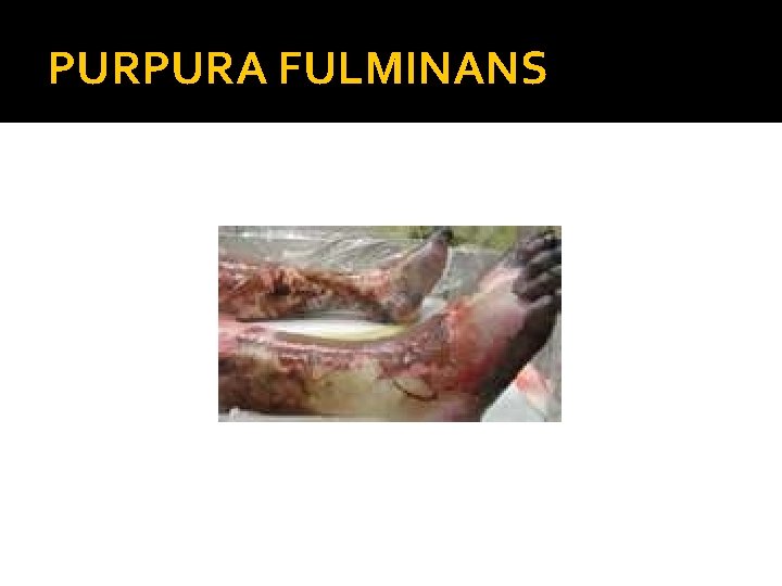 PURPURA FULMINANS 