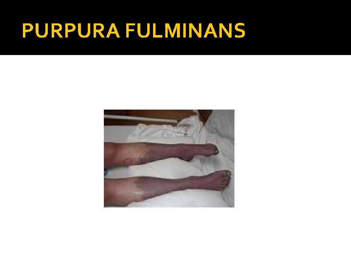 PURPURA FULMINANS 