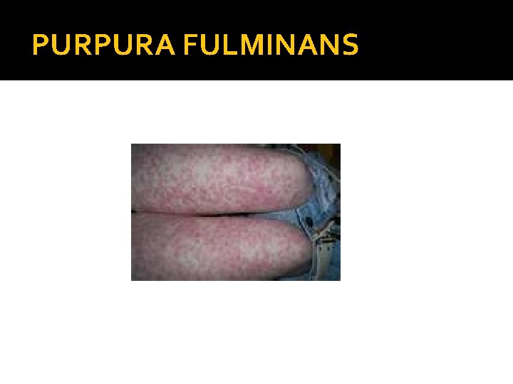 PURPURA FULMINANS 