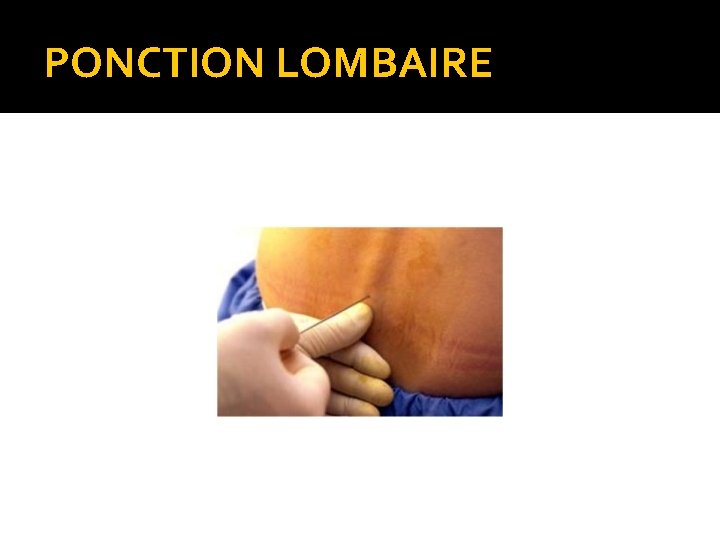 PONCTION LOMBAIRE 