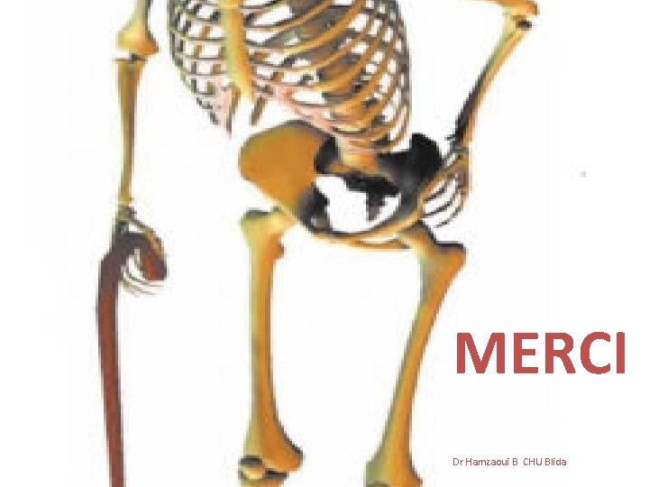 MERCI Dr Hamzaoui B CHU Blida MERCI Dr Hamzaoui B CHU Blida