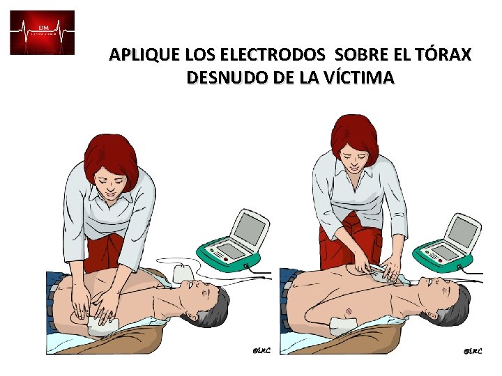 APLIQUE LOS ELECTRODOS SOBRE EL TÓRAX DESNUDO DE LA VÍCTIMA 