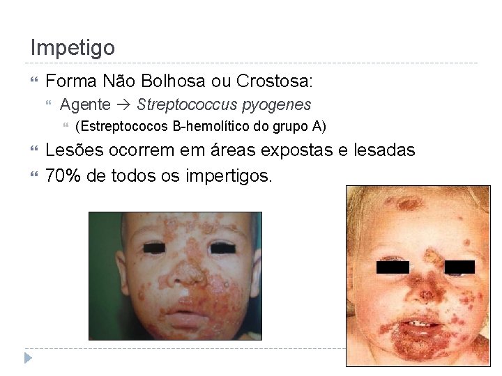 Impetigo Forma Não Bolhosa ou Crostosa: Agente Streptococcus pyogenes (Estreptococos B-hemolítico do grupo A)