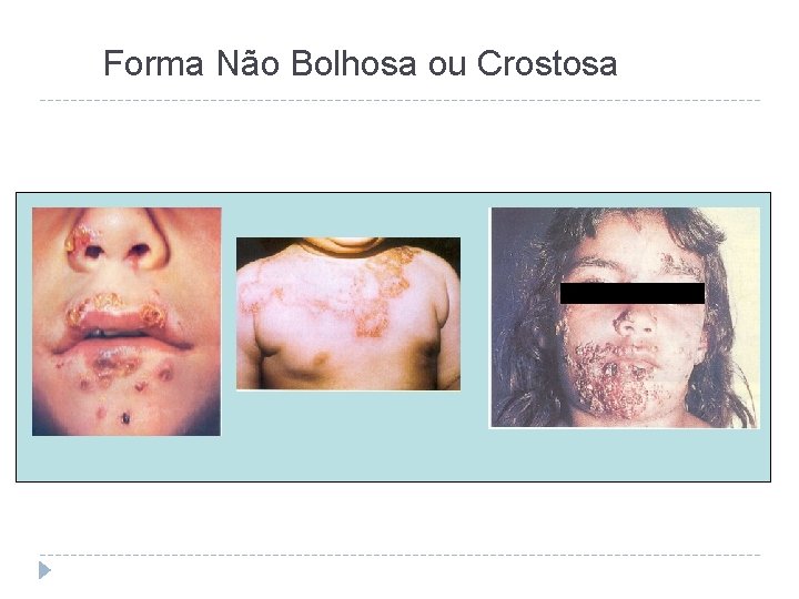 Forma Não Bolhosa ou Crostosa 