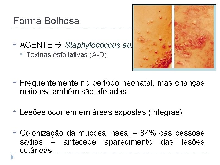 Forma Bolhosa AGENTE Staphylococcus aureus Toxinas esfoliativas (A-D) Frequentemente no período neonatal, mas crianças
