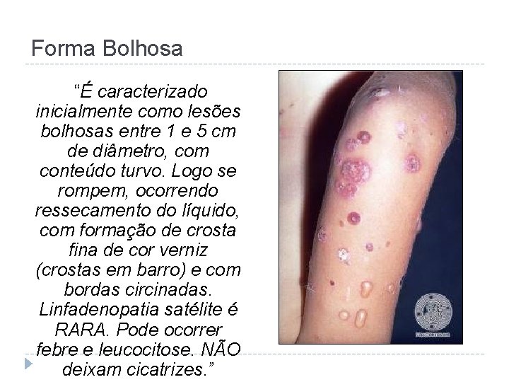 Forma Bolhosa “É caracterizado inicialmente como lesões bolhosas entre 1 e 5 cm de