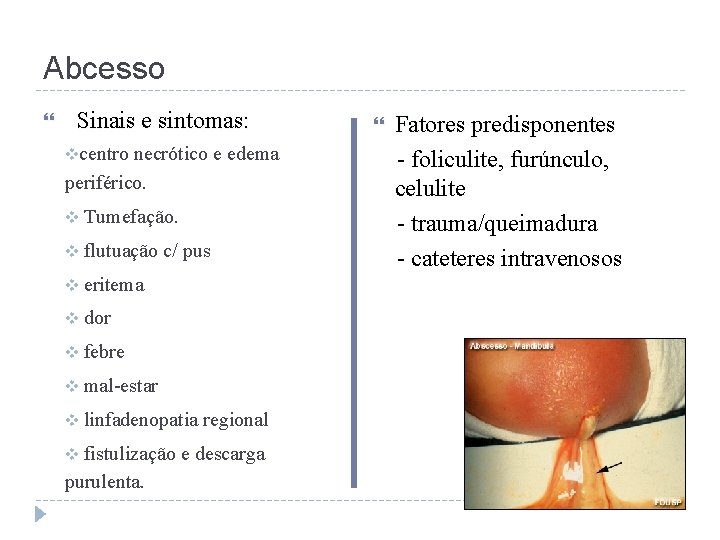 Abcesso Sinais e sintomas: vcentro necrótico e edema periférico. v Tumefação. v flutuação c/