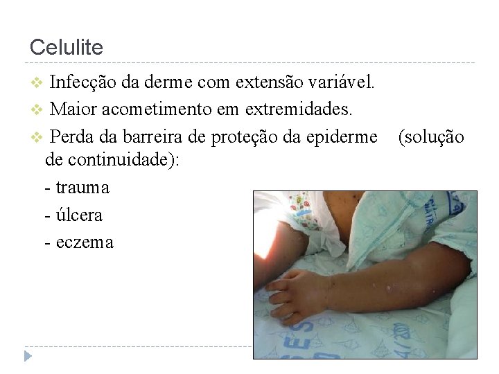 Celulite Infecção da derme com extensão variável. v Maior acometimento em extremidades. v Perda