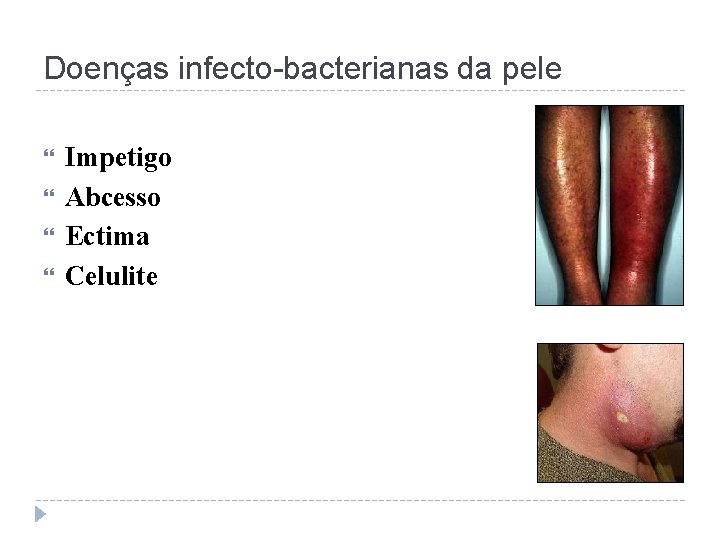 Doenças infecto-bacterianas da pele Impetigo Abcesso Ectima Celulite 