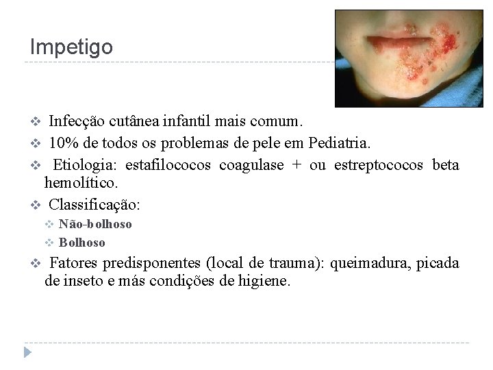 Impetigo Infecção cutânea infantil mais comum. v 10% de todos os problemas de pele