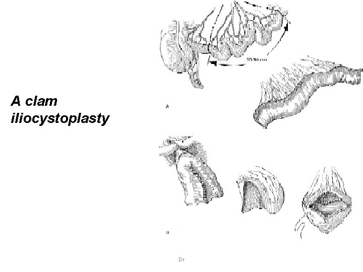A clam iliocystoplasty Dr 