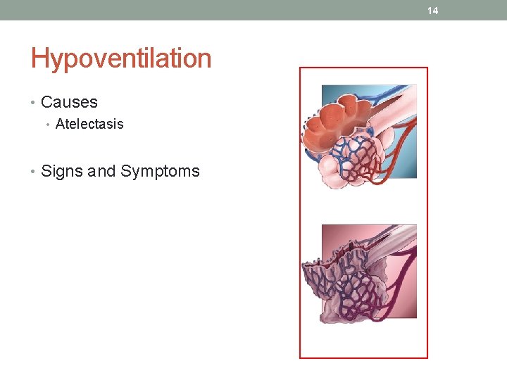 14 Hypoventilation • Causes • Atelectasis • Signs and Symptoms 